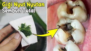 TANPA OBAT INI ITU, SAKIT GIGI MEMBANDEL LANGSUNG SEMBUH DENGAN RESEP INI