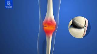 Comprendre l'arthrose du genou