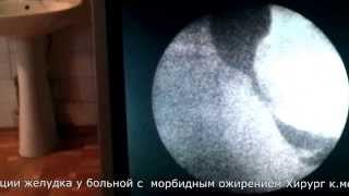 Рентгеноскопия желудка после рукавной резекции желудка. Хирург к.мед.н. Децык Д.А.www.decik.zp.ua