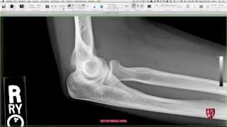 Upper Extremity Trauma Case Conference: Elbow, Wrist, and Hand