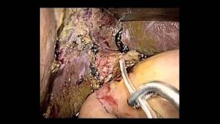 SS03 Best of Video I: V014. LAPAROSCOPIC WHIPPLE PROCEDURE WITH A 2-LAYERED PANCREATOJEJUNOSTOMY