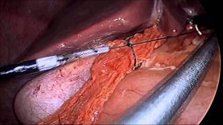 laparoscopic repair of the perforated duodenal ulcer