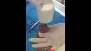 Циркумцизия с использованием одноразового степлера.