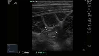 RLQ Pain and Vomiting in 7 year old Girl for 1 day