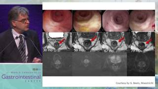 Organ preservation in rectal cancer: How and for whom?