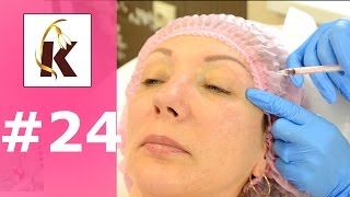 Блефаропластика инъекционная, подтяжка век/как убрать темные круги и мешки под глазами, морщины