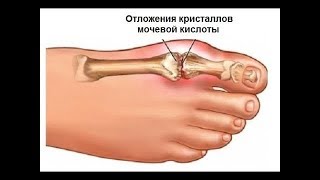 Эти фрукты снижают уровень мочевой кислоты