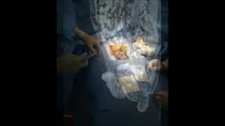 Penile Calciphylaxis with Partial Penectomy by Dr. Wadah Ceifo
