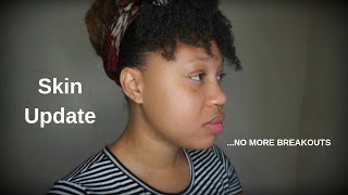 Acne Update 2019 NO MORE BREAKOUTS ! |  EuniyceMari