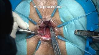 Anatomy and Techniques of Laparoscopic Intersphincteric Resection (ISR) for Low Rectal Cancer