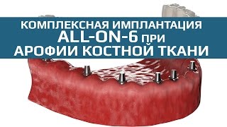Имплантация с немедленной нагрузкой. Комплексная имплантация All-on-6 в условиях атрофии