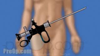 TURBT Transurethral Resection of Bladder Tumor, Female Procedure • PreOp® Patient Education