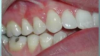 Connective Tissue Graft by West Palm Beach dentist Carlos Boudet, DDS