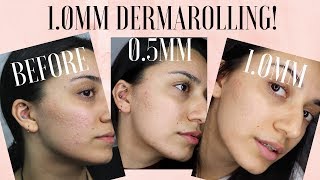 0.5mm vs 1mm dermaroller! | Any difference?