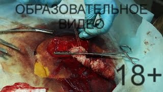 УДАЛЕНИЕ пупочной ГРЫЖИ у телёнка. 18+ Umbilical hernia repair in a calf