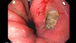 Gastric Ulcers Overture