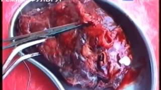 Хирургическое лечение фиброзно-кавернозного туберкулеза - плеврэктомия