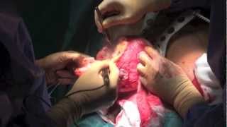 Réduction mammaire - Breast Reduction Surgery