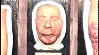 Музей восковых слепков 1МГМУ им. И.М.Сеченова - Museum of wax casts 1MSMU I.M.Sechenov