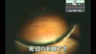 26） 網膜剥離、飛蚊症の20人に一人が網膜に異常があります。