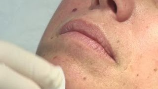 How To Remove Moles From Your Skin