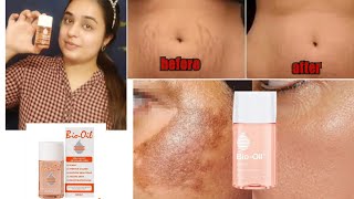 Bio oil : best for dry skin?/ स्ट्रेच मार्क्स का इलाज़।पुराने दाग धब्बो को क्या ये सच मे ठीक कर देगा?