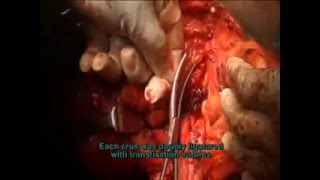Total Amputation for Carcinoma of Penis