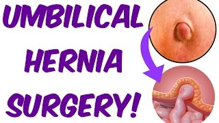Live Surgery - Umbilical Hernia Operation