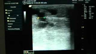 Operatie varice dr Feodor Toni Ablatia prin radiofrecventa VNUS Closure Fast part 1