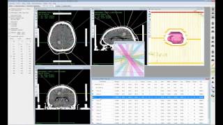 Virtuos 5.1 BETA - MLC Radiosurgery Planning