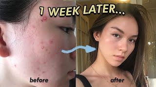 Getting rid of my ACNE with SUBLIMINALS in *1 WEEK* (it worked! ?)