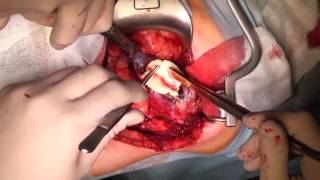 Partial nephrectomy (open - 3 cases)/ Открытая резекция почки (3 операции)