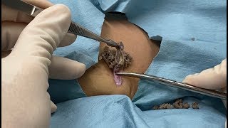 3mm incision. Removal of epidermoid cyst  Dr.Gen