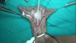 IGICH Hypo W-S TIP with Preputioplasty by Dr. Shivaji Mane
