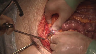 Extralevator Abdominoperineal Resection.