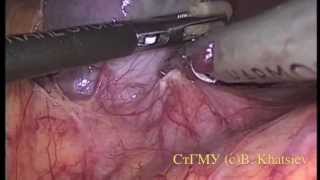 Laparoscopic splenectomy /Лапароскопическая спленэктомия