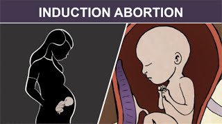 3rd Trimester Induction Abortion: Injection and Stillbirth