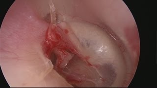 Endoscopic myringoplasty - Miringoplastia endoscópica