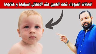 علاج الهالات السودا تحت العين في اسرع وقت