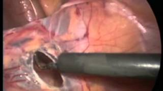 Laparoscopic orchidopexy for cryptorchidism with intra- abdominal testis