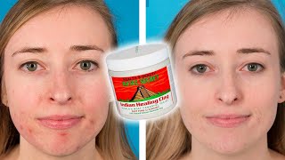 People Try The Aztec Healing Clay Face Mask For Their Acne