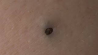Выдавливание большой черной точки/Removal of big blackhead
