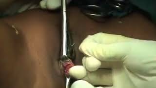 Bartholin gland Marsupialization in Primary Bartholin Cyst