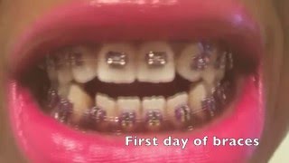Amazing Braces Results after 20 weeks- Open Bite Closed