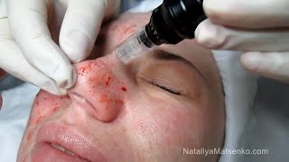 Дермапен (Dermapen) Часть 2