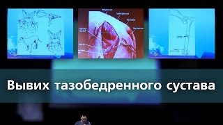 Вывих тазобедренного сустава