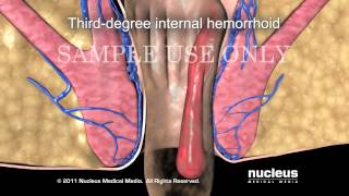 Операция удаления геморроя, геморроидэктомия/Hemorrhoidectomy Hemorrhoid Surgery
