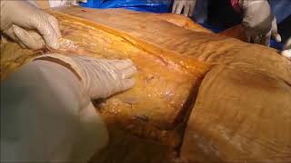 Postural Back Muscle Clinical Aspects - Sanjoy Sanyal