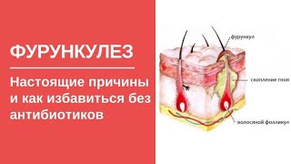 Фурункулез: настоящие причины и как избавиться от фурункулеза без антибиотиков