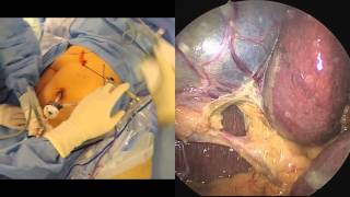 Split Screen First Person Gallbladder Complete Big